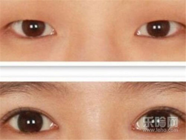 割双眼皮多少钱 护肤 第1张