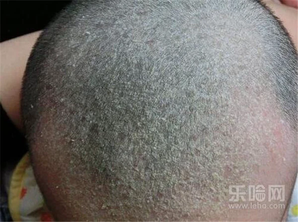 怎么去头屑又快又好 护肤 第3张