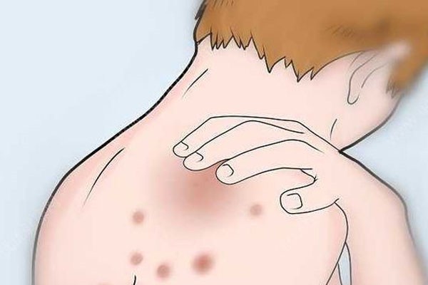 后背长痘痘怎么去除，7个小妙招帮你解决 护肤 第1张