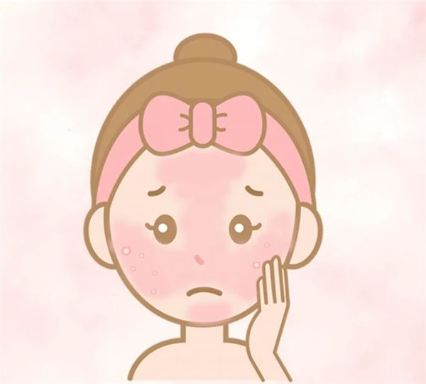 如何分辨「玫瑰痤疮」与「暗疮」，玫瑰痤疮常见4大病发阶段 玫瑰痤疮 暗疮 第6张