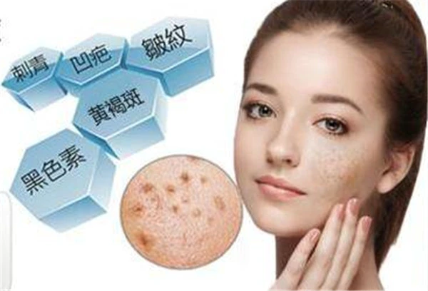 激光祛斑的副作用：处理不及时会留下疤痕 激光 祛斑 第2张