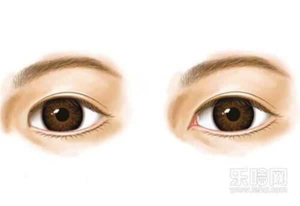 开内眼角会留疤吗 护肤 第2张