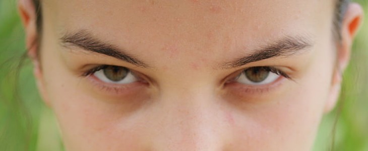 脸上长痘痘怎么快速去除 脸上 痘痘 美妆 第2张