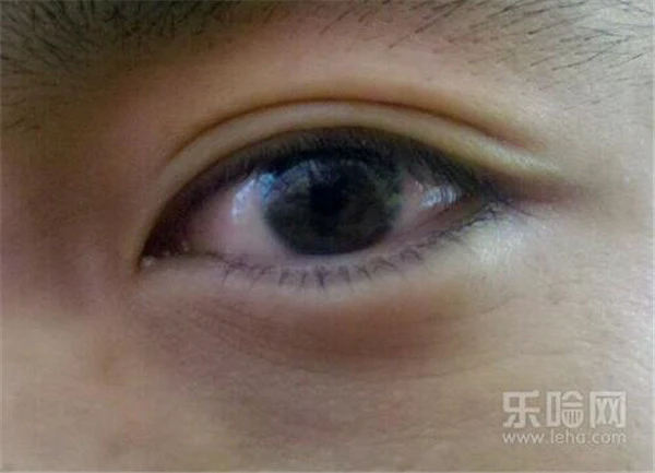 割双眼皮多少钱 护肤 第6张