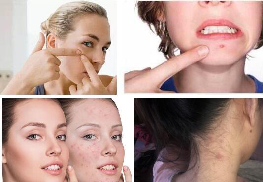 脸上长粉刺是什么原因，脸上长粉刺的8个原因 粉刺 脸上长粉刺是什么原因 美容 第1张