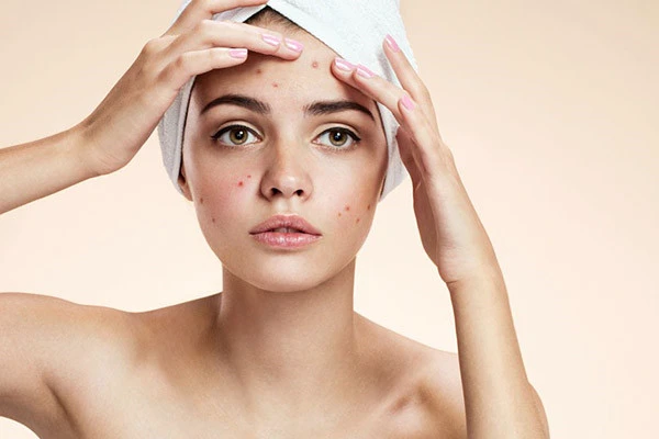 痘痘肌护肤六大注意事项 肌肤 第3张