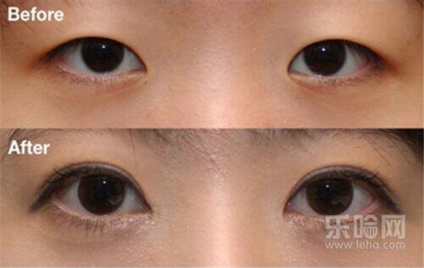 开内眼角会留疤吗 护肤 第1张