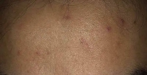 理肤泉青春痘调理精华乳怎么样，理肤泉青春痘调理精华乳使用测评 精华 理肤泉 第5张