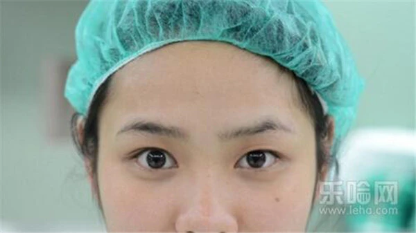 割双眼皮多少钱 护肤 第5张