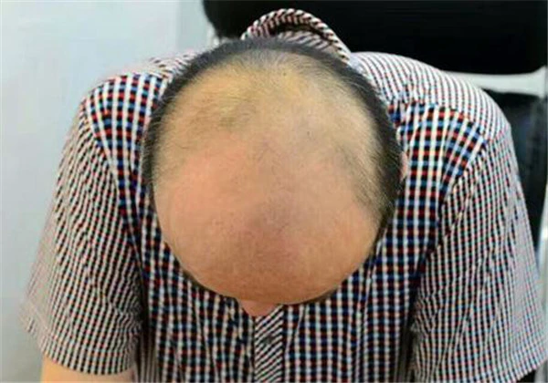 种植头发有什么害处 护肤 第3张