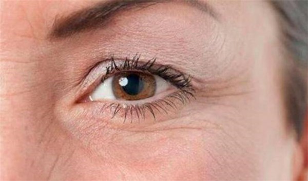 怎样去除眼角鱼尾纹 美妆 第1张