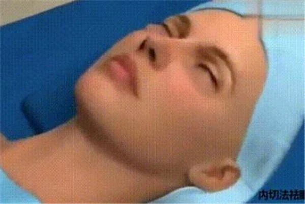 让眼袋消失的「妙招」：「外路」去眼袋紧致下眼皮 眼袋 妙招 第4张