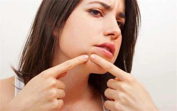 怎么去痘痘痘印改善皮肤 痘印 痘痘 美妆 第2张