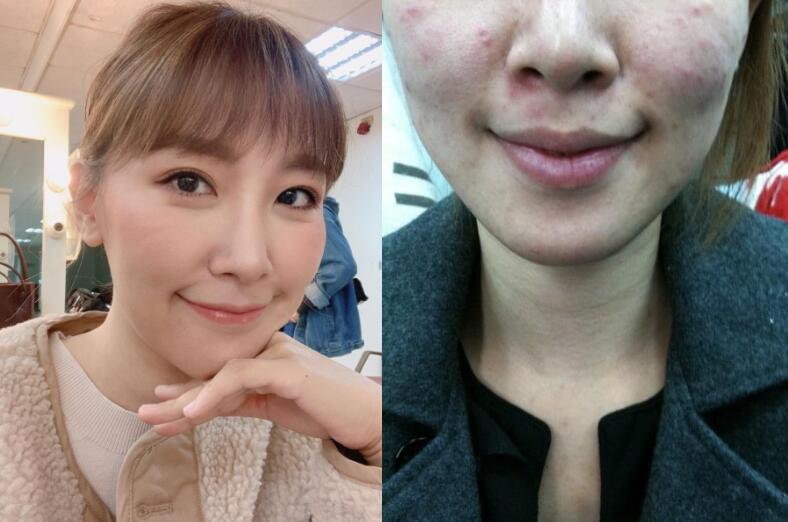 女星李懿的「酒糟肌奋斗史」，5大原则找回自信美肌 美肌 酒糟肌 第1张