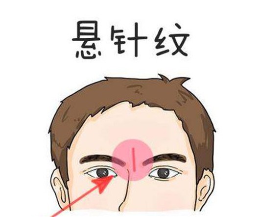 额头中间的竖纹怎样能去掉 皱纹 额头皱纹 美妆 第1张