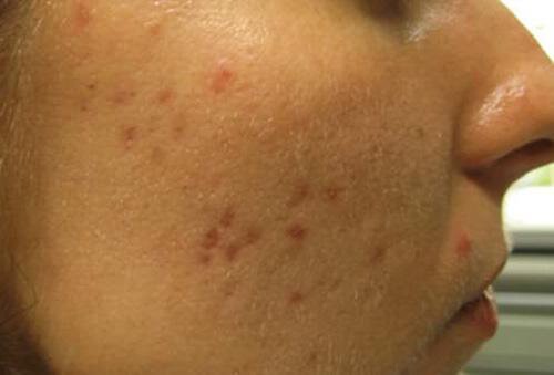 去痘印最有效的方法，导致痤疮形成疤痕的原因 护肤 第1张