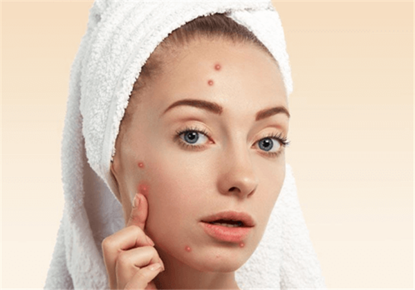 脸上痘痘反复发作怎么办，5招帮你赶走长痘烦恼 护肤 第1张