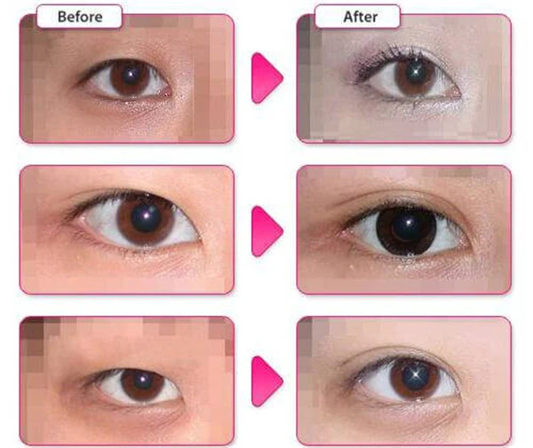 割双眼皮有什么危害性，埋线双眼皮后遗症 护肤 第6张