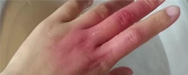 烫伤怎么做才不会留疤，烫伤疤痕怎么去除 护肤 第1张