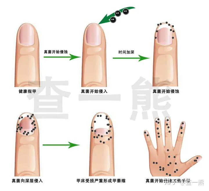 治疗灰指甲亮甲好用还是楚甲 灰指甲 亮甲 楚甲 美妆 第3张