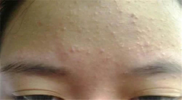 开口粉刺和闭口怎么区分 护肤 第3张 开口粉刺和闭口怎么区分 护肤 第3张