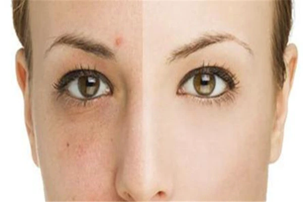 巧妙去除闭口粉刺的方法：选择适合自己肤质的化妆品 闭口 粉刺 第3张