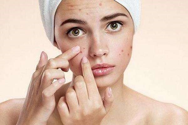 天气热的时候脸上就会长出痘痘，原因是什么 痤疮 第1张