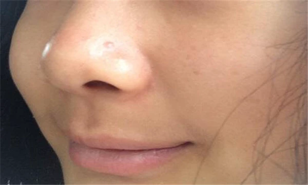 熬夜脸上长痘痘怎么可以消除 护肤 第2张 熬夜脸上长痘痘怎么可以消除 护肤 第2张