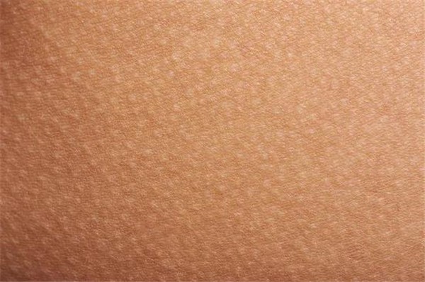 毛周角化为慢性毛囊角化性疾病，因毛孔堵塞出现红斑 毛周角化 疾病 第1张