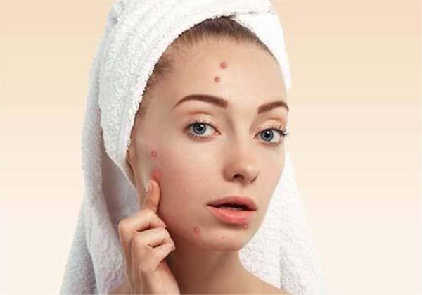 下巴长痘痘是什么原因,有什么祛痘的方法 护肤 第1张 下巴长痘痘是什么原因,有什么祛痘的方法 护肤 第1张