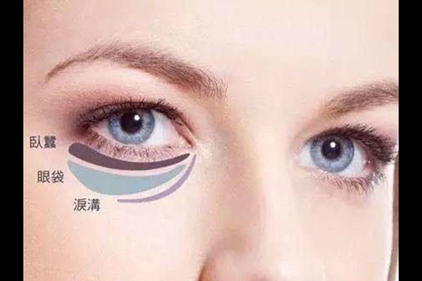 泪沟是怎么来的，泪沟要怎么消除 皮肤 第1张