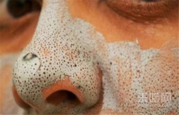 开口粉刺和闭口怎么区分 护肤 第1张 开口粉刺和闭口怎么区分 护肤 第1张