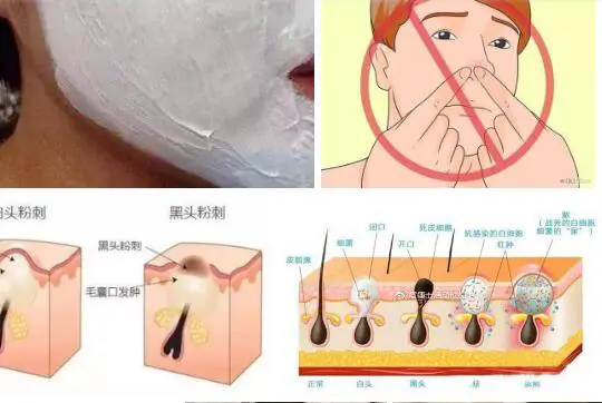 黑头是怎么来的，该怎样解决黑头 黑头 美容 第4张