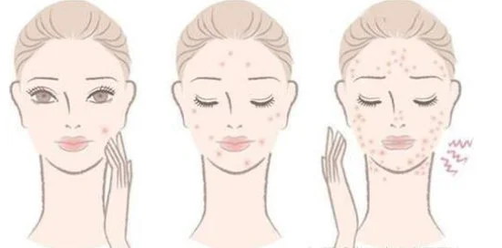 脸颊两边老是长痘痘是怎么回事 长痘 脸颊长痘 美妆 第3张