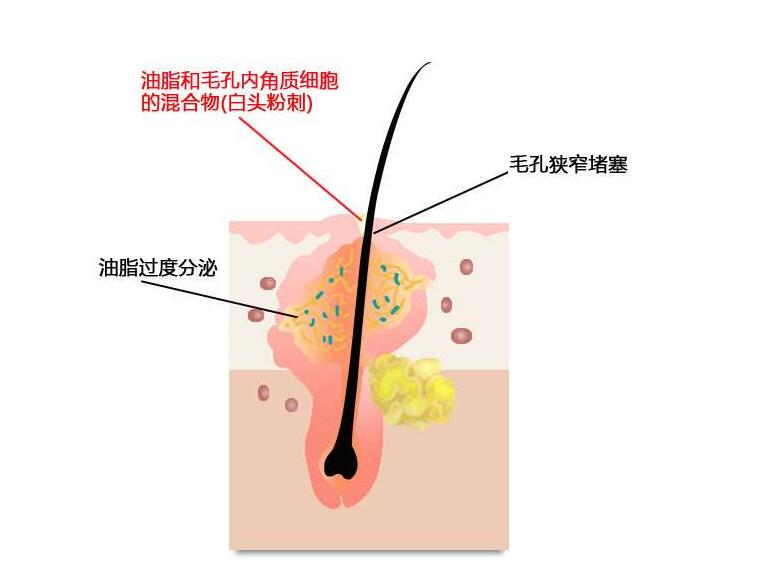 毛孔发炎怎么办，毛孔消炎方法 毛孔 毛孔发炎怎么样 盘点毛孔发炎护肤方法 美容 第1张