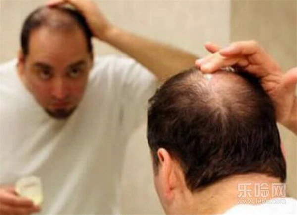 秃头是什么原因造成的 护肤 第3张
