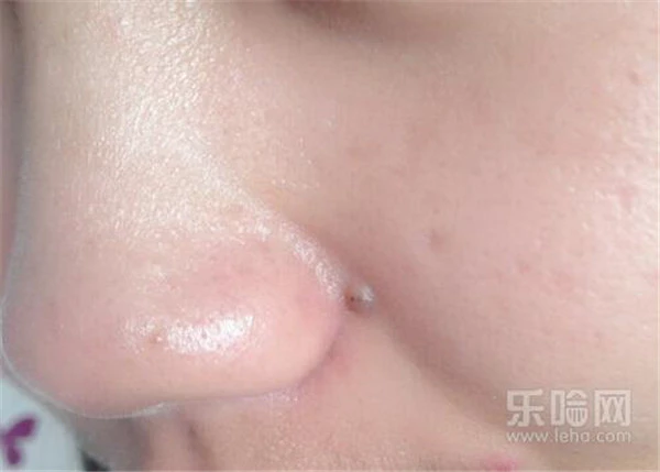 黑头多不理它会怎么样 护肤 第4张