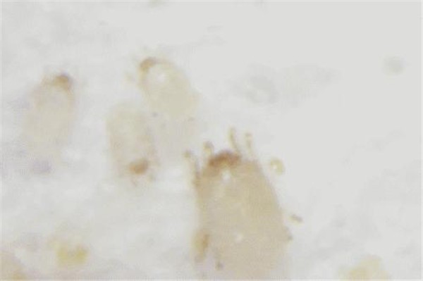 脸上有螨虫怎么办，做好哪些工作才能去除 螨虫 第1张