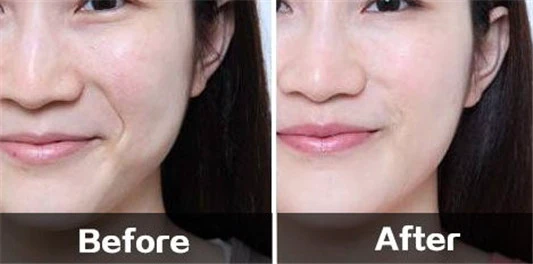 打完法令纹晚上疼一晚怎么回事 法令纹 玻尿酸 美妆 第2张