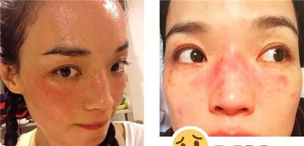 皮肤过敏的原因有哪些，哪些人容易皮肤过敏 过敏 皮肤 第1张