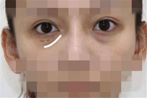 让眼袋消失的「妙招」：「外路」去眼袋紧致下眼皮 眼袋 妙招 第1张