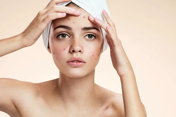 长了闭口粉刺怎么办，闭口粉刺怎么去除 粉刺 第2张