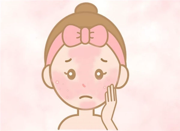 如何分辨「玫瑰痤疮」与「暗疮」，玫瑰痤疮常见4大病发阶段 玫瑰痤疮 暗疮 第4张