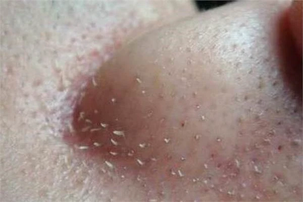 激光祛黑头的价格怎么样，会不会很贵 黑头 第2张