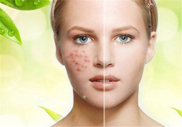 痘痘里面挤出来的白色东西是什么，是不是挤出来就好了 护肤 第1张