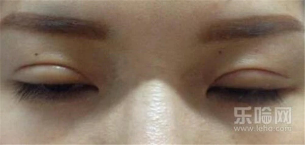 割双眼皮多少钱 护肤 第2张