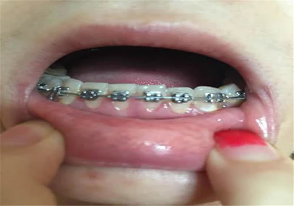 矫正虎牙会改变脸型吗 护肤 第4张 矫正虎牙会改变脸型吗 护肤 第4张