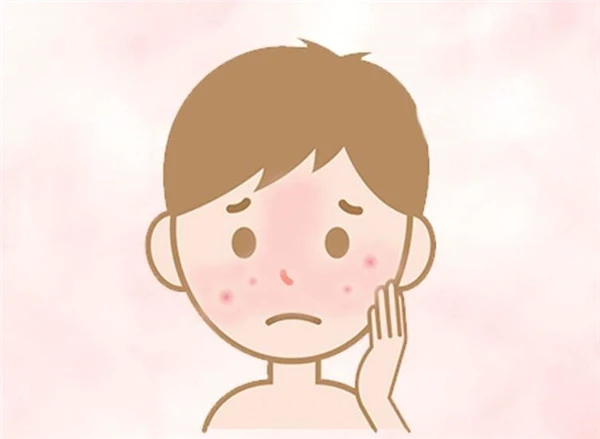 如何分辨「玫瑰痤疮」与「暗疮」，玫瑰痤疮常见4大病发阶段 玫瑰痤疮 暗疮 第3张