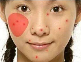 脸颊两边老是长痘痘是怎么回事 长痘 脸颊长痘 美妆 第2张