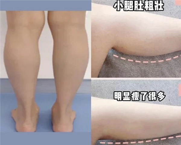 轻松改变小腿外翻瘦出筷子腿！如何判断小腿肌类型 筷子腿 小腿外翻 第2张